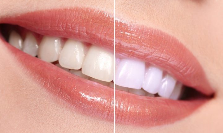 Como funciona o Clareamento Dental
