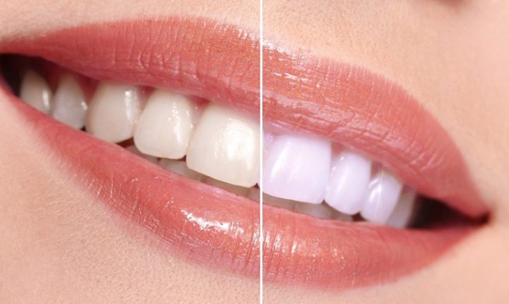 Como funciona o Clareamento Dental